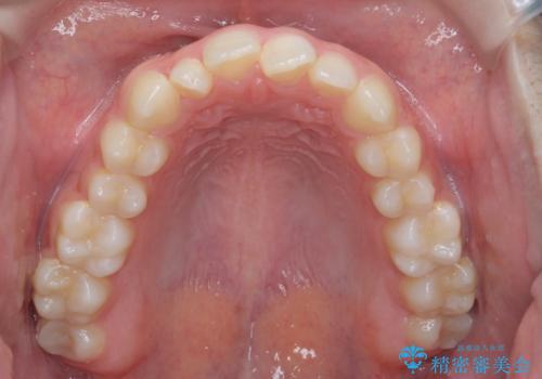前歯のねじれ、がたつきをしっかり改善　部分ワイヤー+マウスピース矯正の治療前