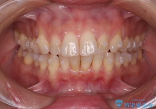 【インビザライン】上の前歯出ているのが気になるの治療中