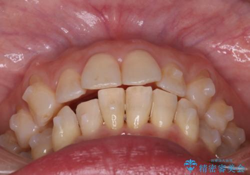 【インビザライン】上の前歯出ているのが気になるの治療中
