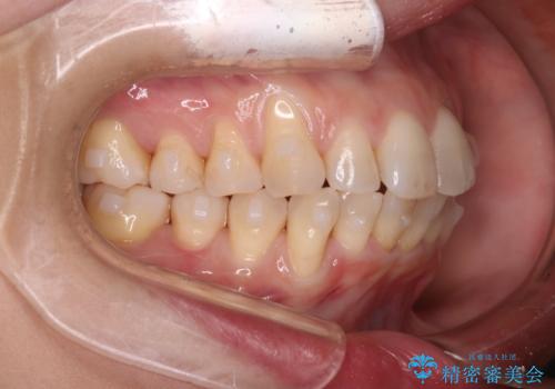 【インビザライン】上の前歯出ているのが気になるの治療中