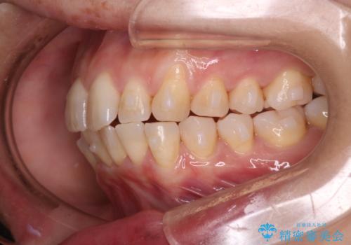 【インビザライン】上の前歯出ているのが気になるの治療中