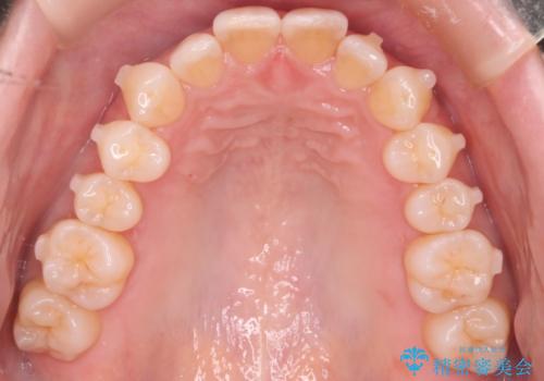 【インビザライン】上の前歯出ているのが気になるの治療中