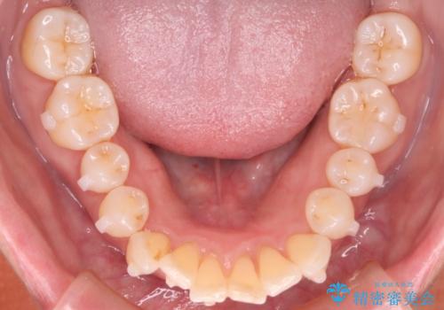 【インビザライン】上の前歯出ているのが気になるの治療中