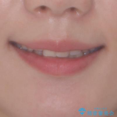 捻れて前に出ている前歯 ワイヤー装置での非抜歯矯正の治療前(顔貌)