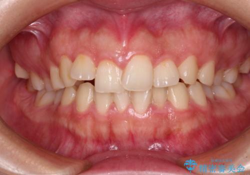 捻れて前に出ている前歯 ワイヤー装置での非抜歯矯正の症例 治療前