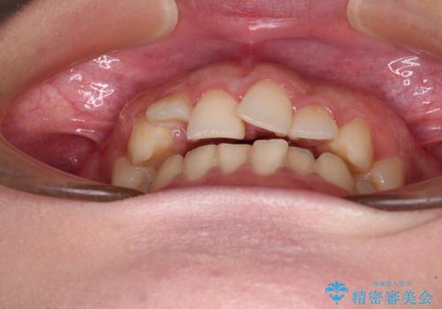 捻れて前に出ている前歯 ワイヤー装置での非抜歯矯正の治療前