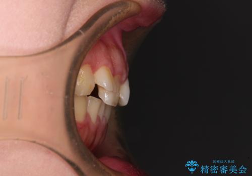 捻れて前に出ている前歯 ワイヤー装置での非抜歯矯正の治療前