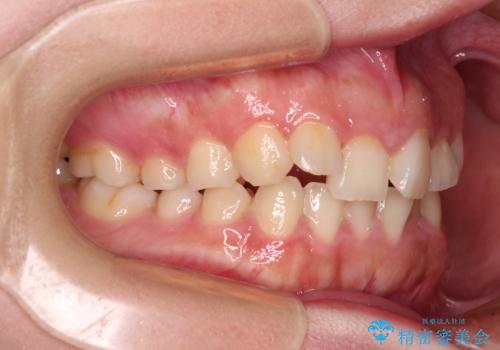 捻れて前に出ている前歯 ワイヤー装置での非抜歯矯正の治療前