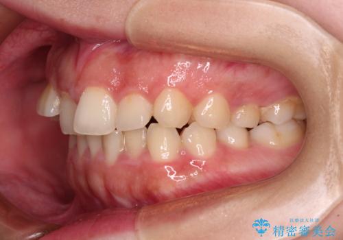 捻れて前に出ている前歯　ワイヤー装置での非抜歯矯正の治療前