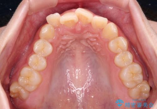 捻れて前に出ている前歯 ワイヤー装置での非抜歯矯正の治療前