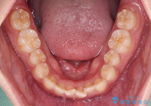 捻れて前に出ている前歯 ワイヤー装置での非抜歯矯正の治療前