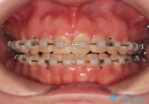 捻れて前に出ている前歯 ワイヤー装置での非抜歯矯正の治療中