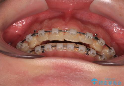 捻れて前に出ている前歯 ワイヤー装置での非抜歯矯正の治療中
