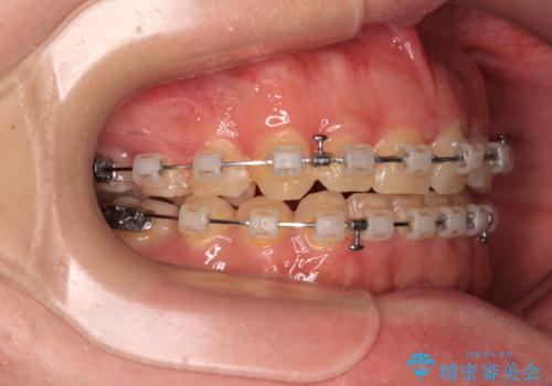 捻れて前に出ている前歯　ワイヤー装置での非抜歯矯正の治療中