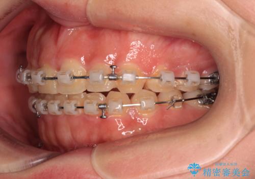 捻れて前に出ている前歯 ワイヤー装置での非抜歯矯正の治療中