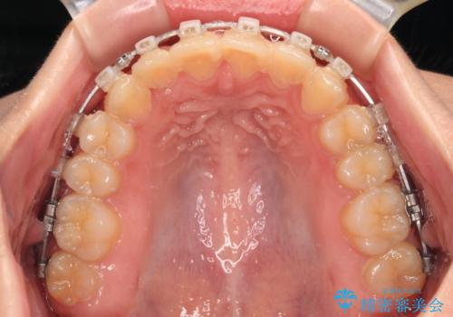 捻れて前に出ている前歯 ワイヤー装置での非抜歯矯正の治療中