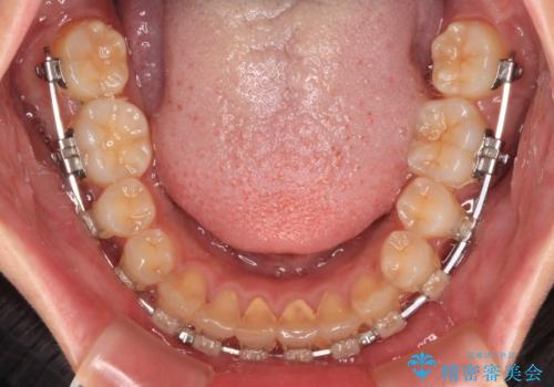 捻れて前に出ている前歯 ワイヤー装置での非抜歯矯正の治療中