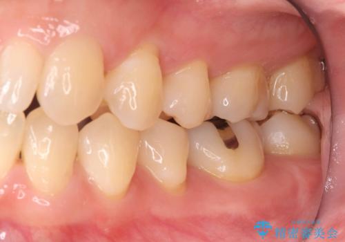 銀歯の段差と虫歯リスクを改善|ラバーダム防湿下で行うセラミックインレー治療の治療前