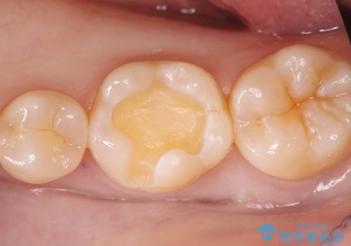 銀歯の段差と虫歯リスクを改善|ラバーダム防湿下で行うセラミックインレー治療の治療中