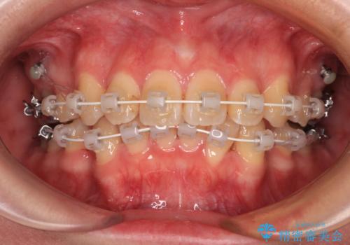デコボコだらけの歯列をきれいに ワイヤー装置での抜歯矯正治療の治療中
