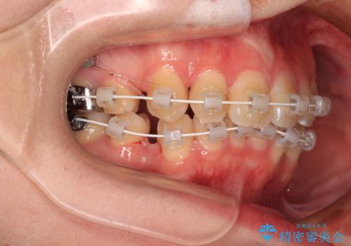 デコボコだらけの歯列をきれいに ワイヤー装置での抜歯矯正治療の治療中