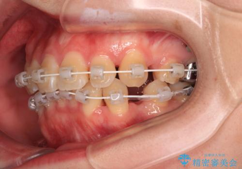 デコボコだらけの歯列をきれいに　ワイヤー装置での抜歯矯正治療の治療中