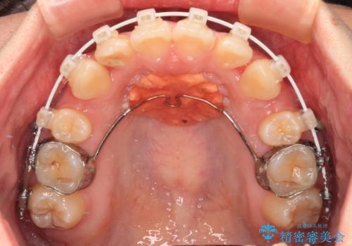デコボコだらけの歯列をきれいに　ワイヤー装置での抜歯矯正治療の治療中