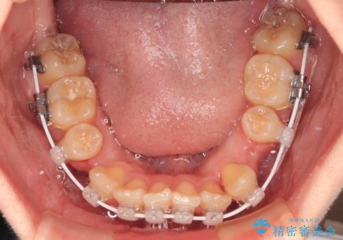 デコボコだらけの歯列をきれいに ワイヤー装置での抜歯矯正治療の治療中