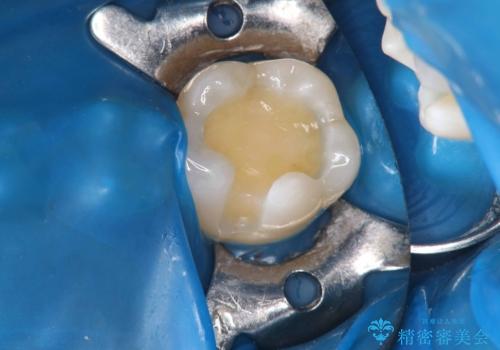 銀歯の段差と虫歯リスクを改善|ラバーダム防湿下で行うセラミックインレー治療の治療中