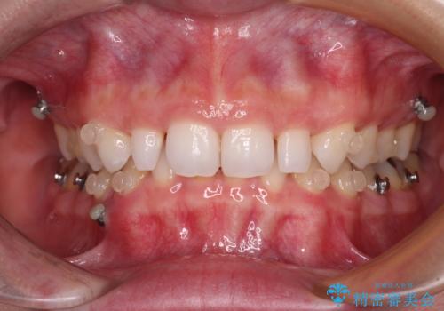 前歯のデコボコと小さい歯を改善　インビザラインとオールセラミッククラウンの治療中