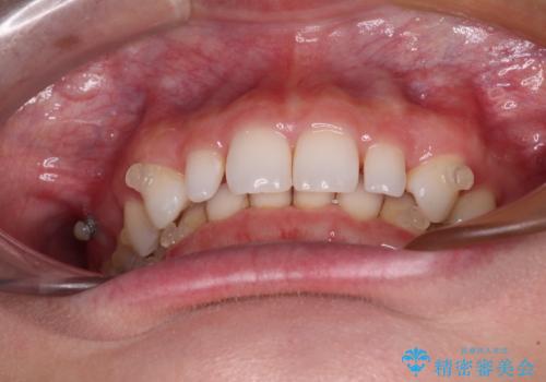 前歯のデコボコと小さい歯を改善 インビザラインとオールセラミッククラウンの治療中