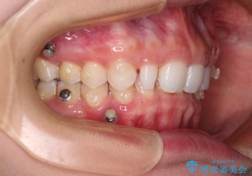 前歯のデコボコと小さい歯を改善　インビザラインとオールセラミッククラウンの治療中