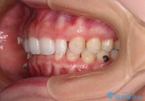 前歯のデコボコと小さい歯を改善　インビザラインとオールセラミッククラウンの治療中