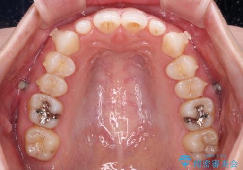 前歯のデコボコと小さい歯を改善 インビザラインとオールセラミッククラウンの治療中