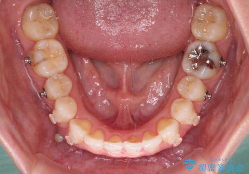 前歯のデコボコと小さい歯を改善　インビザラインとオールセラミッククラウンの治療中