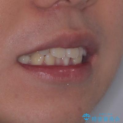 全体的なデコボコをスッキリと ワイヤー装置での抜歯矯正の治療前(顔貌)