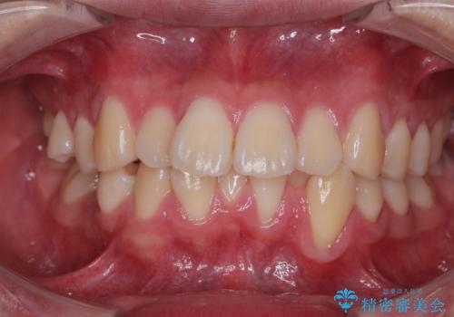 全体的なデコボコをスッキリと ワイヤー装置での抜歯矯正の治療前