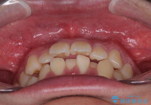 全体的なデコボコをスッキリと　ワイヤー装置での抜歯矯正の治療前