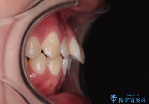 全体的なデコボコをスッキリと　ワイヤー装置での抜歯矯正の治療前