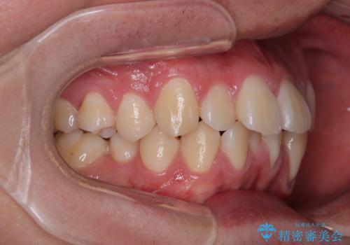 全体的なデコボコをスッキリと　ワイヤー装置での抜歯矯正の治療前