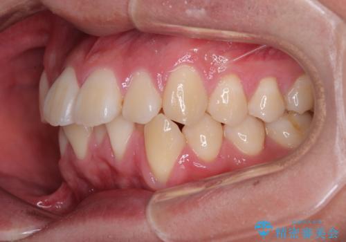 全体的なデコボコをスッキリと ワイヤー装置での抜歯矯正の治療前