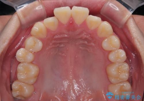 全体的なデコボコをスッキリと　ワイヤー装置での抜歯矯正の治療前