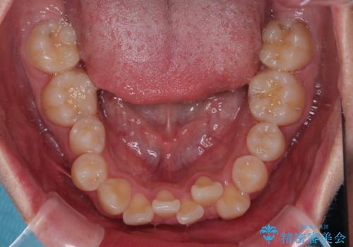 全体的なデコボコをスッキリと ワイヤー装置での抜歯矯正の治療前
