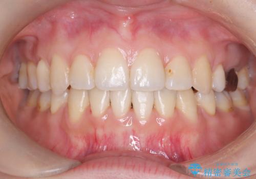 【ワイヤー矯正】口元を下げたい、下の歯の凹凸を無くしたいの治療後