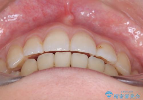 【ワイヤー矯正】口元を下げたい、下の歯の凹凸を無くしたいの治療後