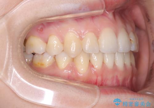【ワイヤー矯正】口元を下げたい、下の歯の凹凸を無くしたいの治療後