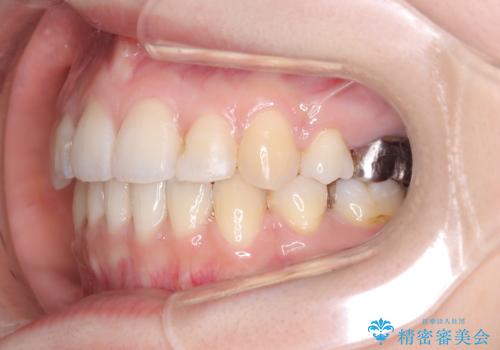 【ワイヤー矯正】口元を下げたい、下の歯の凹凸を無くしたいの治療後