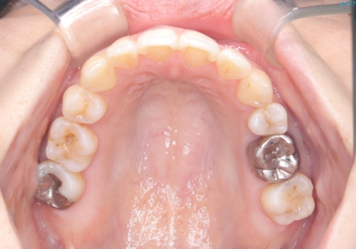 【ワイヤー矯正】口元を下げたい、下の歯の凹凸を無くしたいの治療後