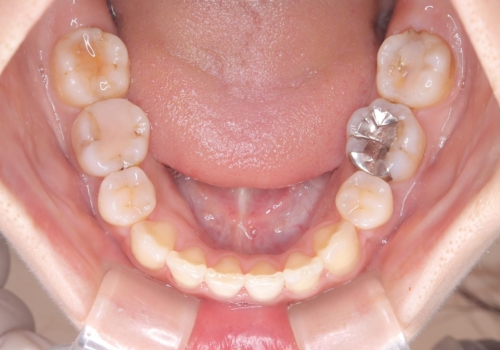 【ワイヤー矯正】口元を下げたい、下の歯の凹凸を無くしたいの治療後