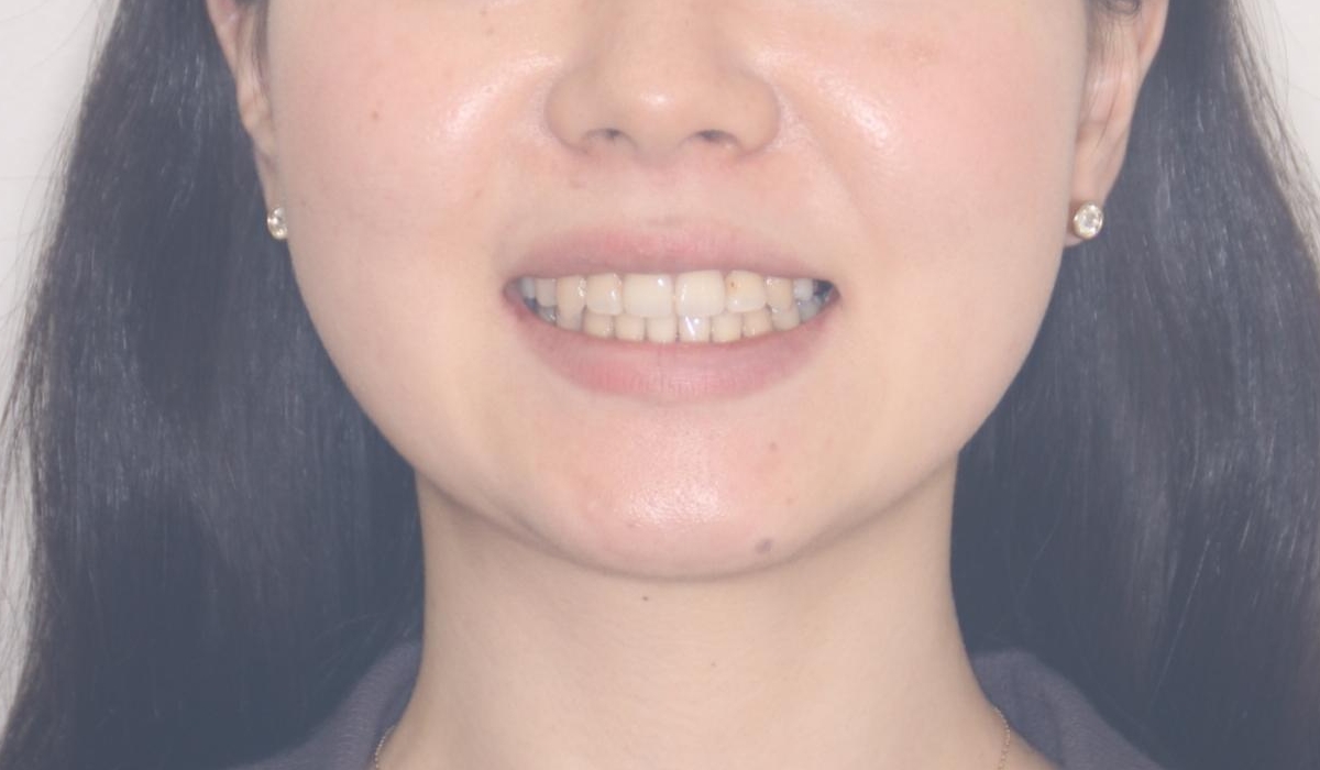 【ワイヤー矯正】口元を下げたい、下の歯の凹凸を無くしたいの治療後(顔貌)